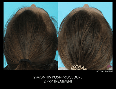 Female Hair Loss - Before and After