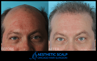 Male Hair Loss in Chicago, IL | Aesthetic Scalp