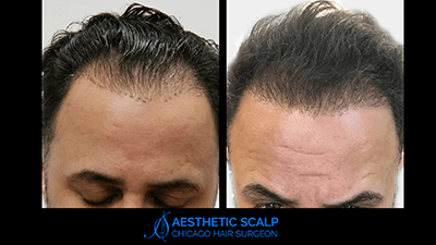 Forehead Reduction in Chicago, IL | Aesthetic Scalp